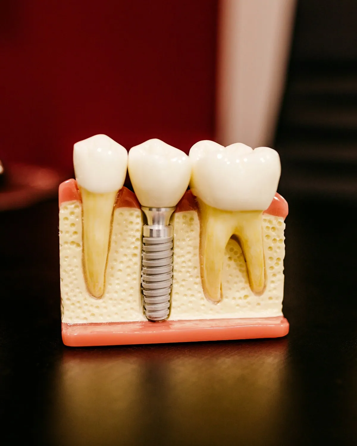 Çene modeli üzerinde implant ve kron